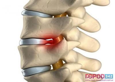 Что такое межпозвонковая грыжа и как с этим жить